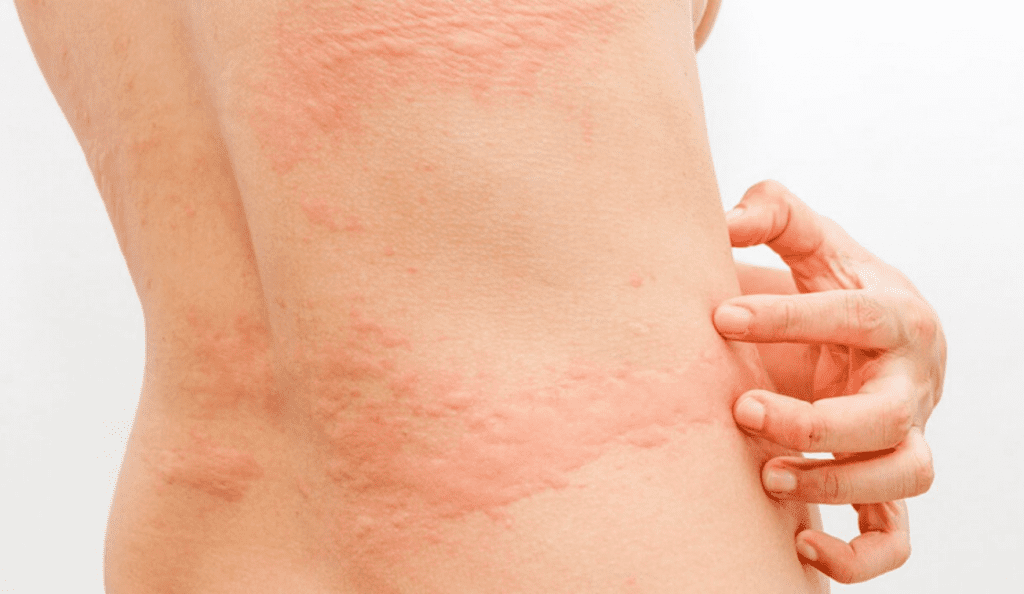 Tipos de Alergia en la Piel y las ronchas