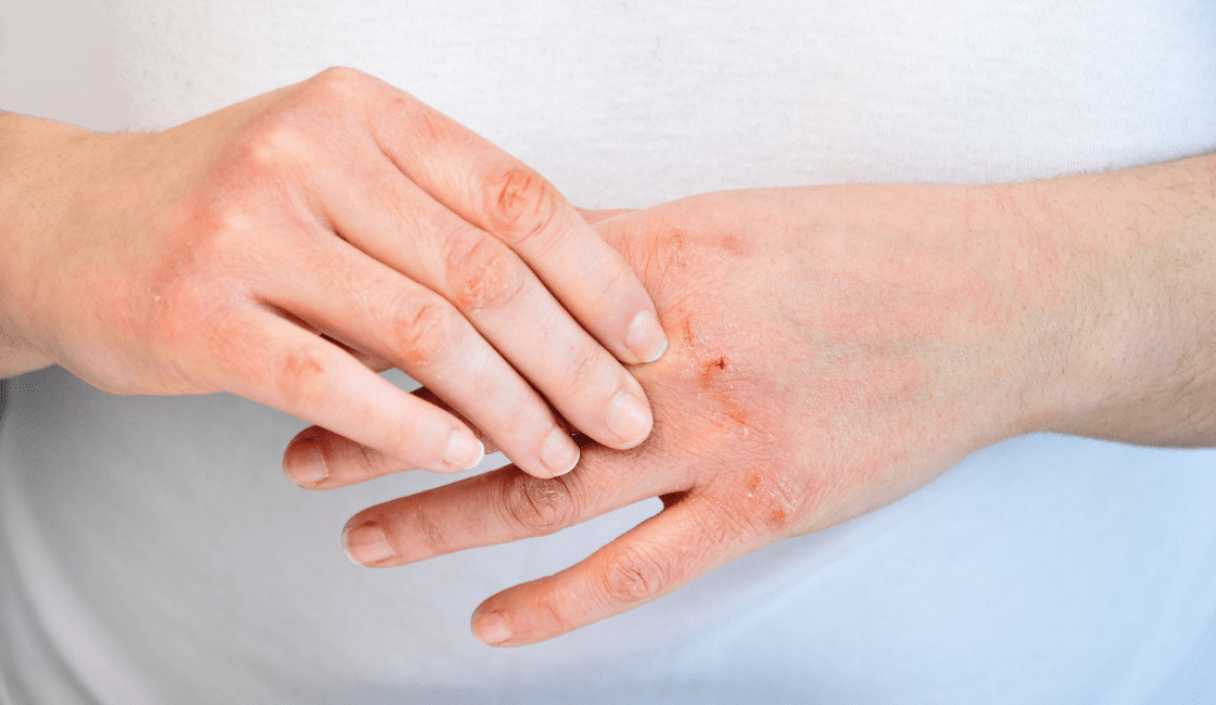 dermatitis por contacto entre las alergias 
