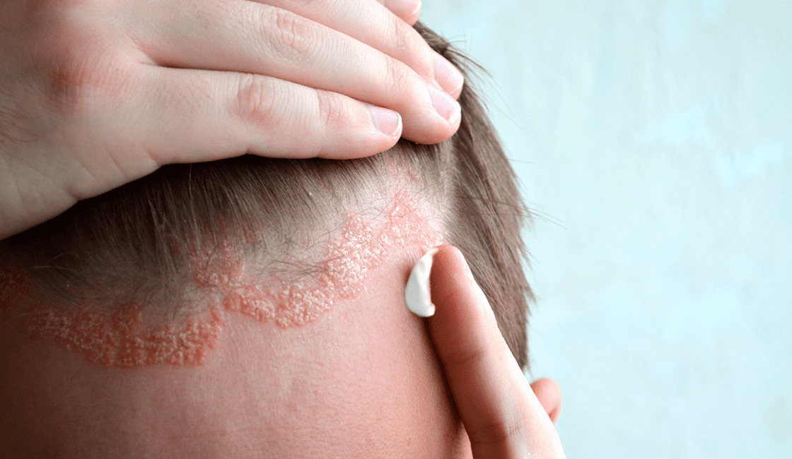 Dermatitis seborreica entre los tipos de ronchas