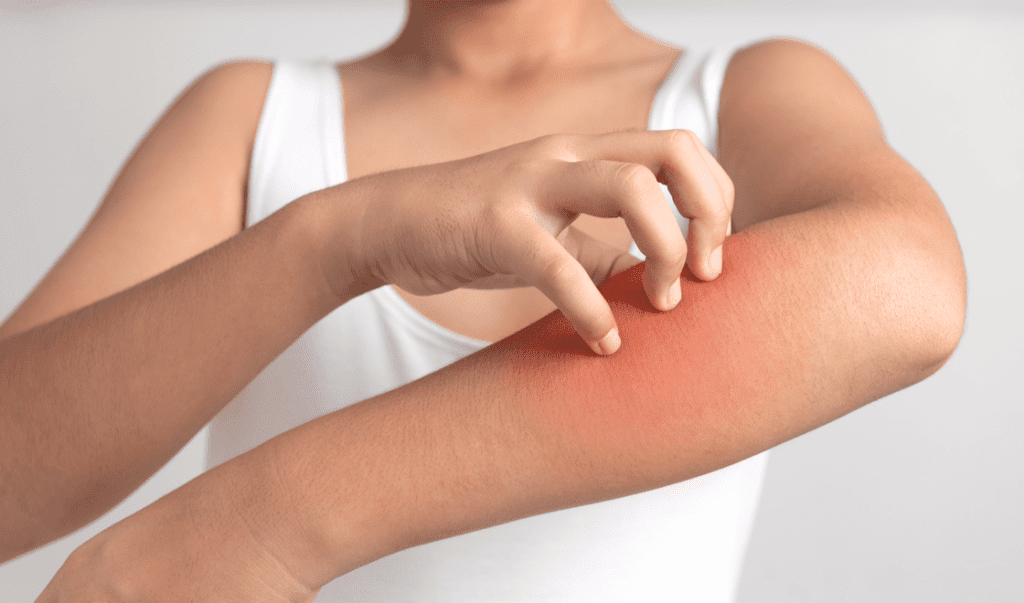 brazo de mujer con alergia en la piela